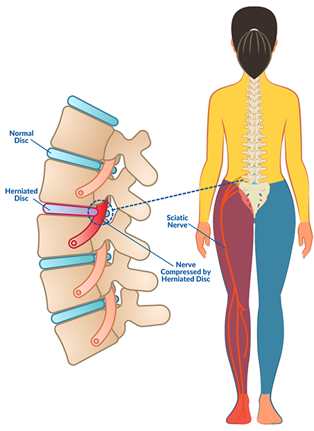 Graphic showing Disc Bulge