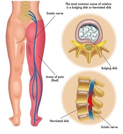  Conditions Elliott Chiropractic Treats - Inside graphic of the human body showing nervs running down the leg