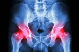 Hip imbalance xray