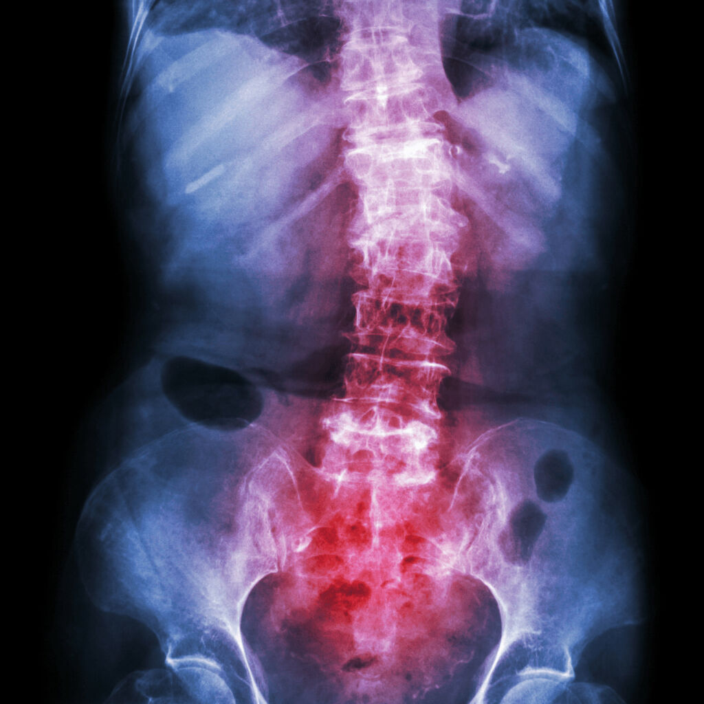 xray of spine - Popping Your Back