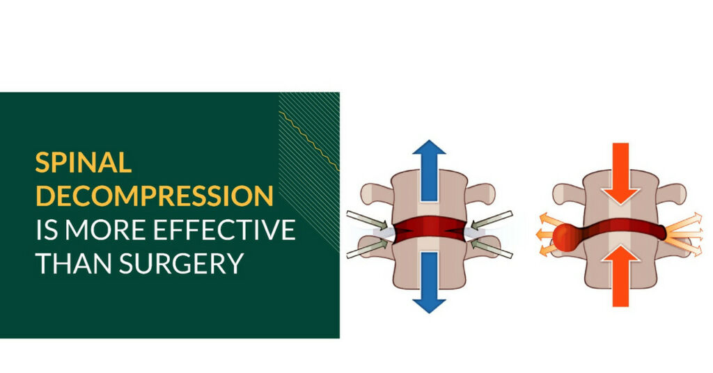 Graphic that says "Spinal Decompression is more effective than surgery"